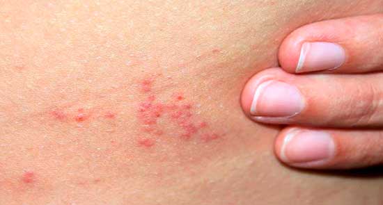 علامات لدغة